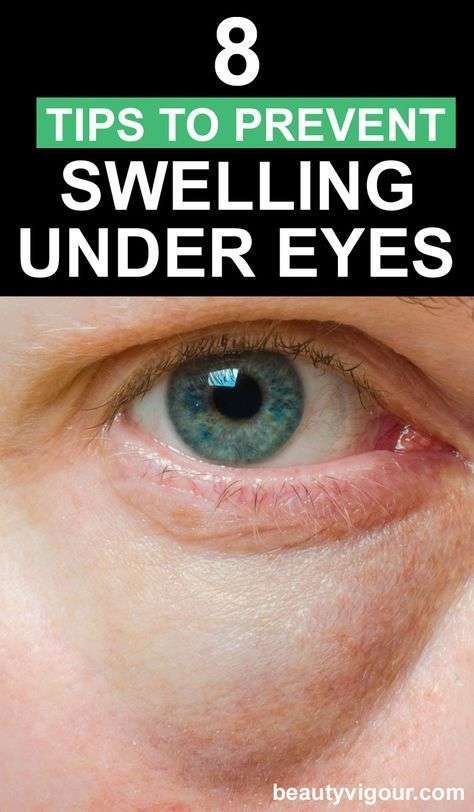 8 Tips to Prevent Swelling under Eye
