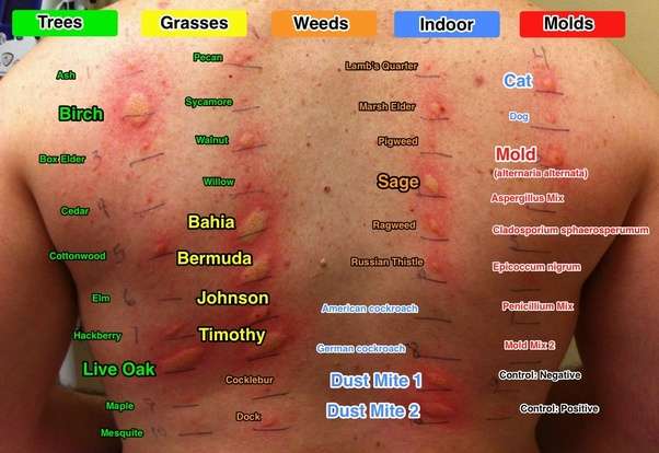 How Do They Test For Food Allergies KnowYourAllergy